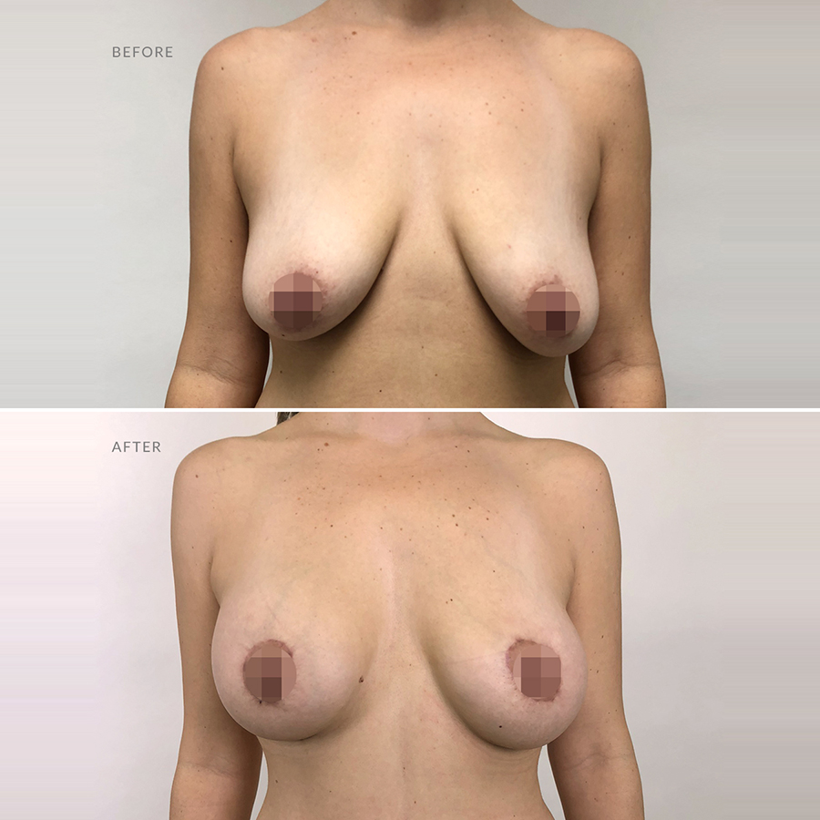 360-sleeve-clinic-post-op-surgeries-breast-lift-mastopexy