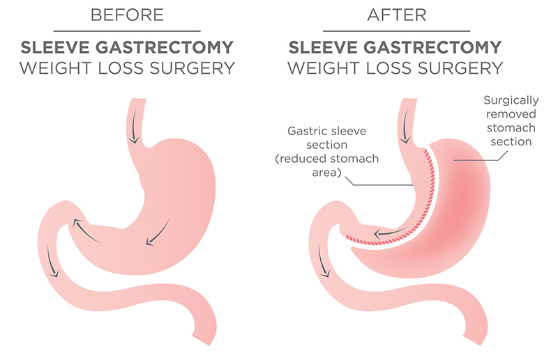 How Gastric Sleeve is Performed