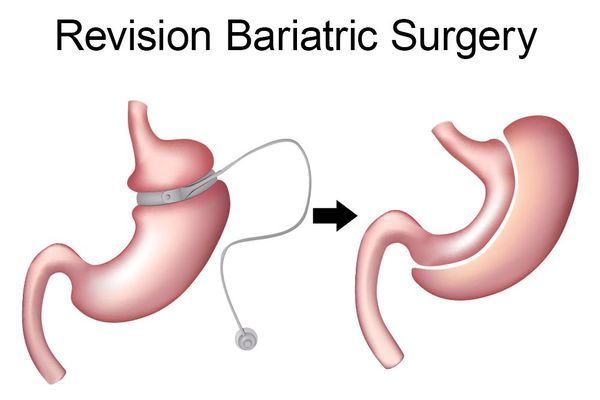 Revision-Bariatric-Surgery