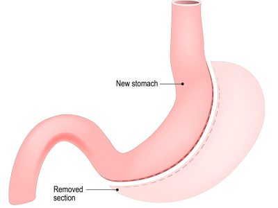How Does Gastric Sleeve Cause You to Lose Weight?
